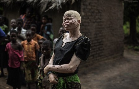 Di Afrika, Orang Albino Diburu untuk Ritual Sihir